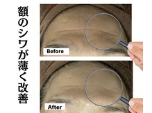 グレースティー 森町 箕面/額のしわが薄く改善★