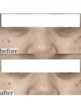 ヴェルシック(Belchic)/目の下のたるみでお悩みの方へ