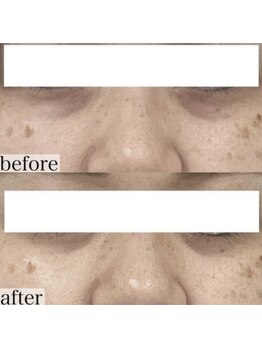 ヴェルシック(Belchic)/目の下のたるみでお悩みの方へ