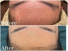 サロンドフェイス(Salon de Faith)/ハーブピーリング