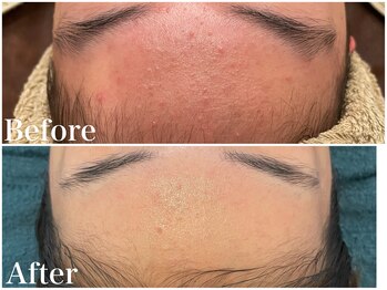 サロンドフェイス(Salon de Faith)/ハーブピーリング