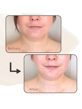 ヴィセル(VISEL)/光フェイシャル