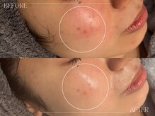 シェステ ゴジュウヨン(shesthe54)/症例写真｜ニキビケア