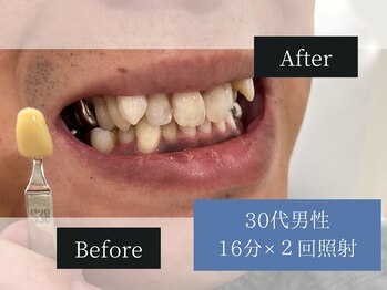 ホワイトニングカフェ 荻窪店(WhiteningCafe)/◎歯のホワイトニング施術写真◎