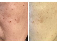 クリスタル(Crystal)/シミケア直後からお化粧OK