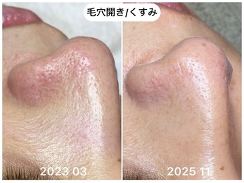 フラックス 京都(FLUX)/【エンビロン】毛穴集中コース