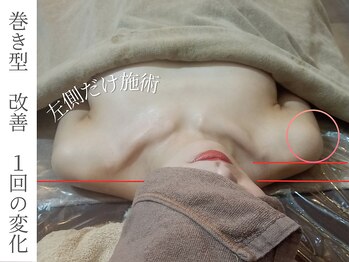 エナボン 上野(ENABON)/ウェディング前のバストアップ