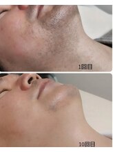 キナリ(kinari)/ヒゲ光脱毛10回目