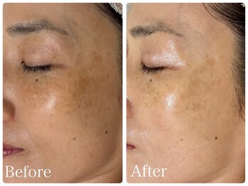 ロイヤル(ROYAL)/シミ/くすみ改善症例