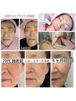 美 ウツクシ(美 U.tsu.ku.shi)/プラズマ×幹細胞 肌質改善