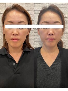 長寿鍼灸院 長寿整骨院/美容鍼50本の効果★小顔効果