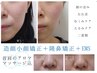 小顔特化◆隆鼻矯正＋小顔＋首肩マッサージ/左右対称美小顔,小顔,隆鼻,鼻65分