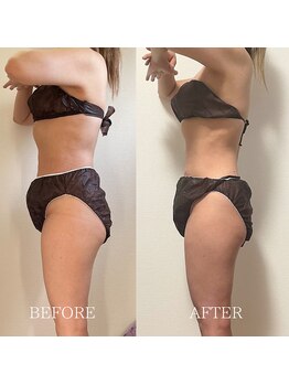 ブルーム(BLOOM)/痩身プログラム3カ月