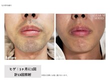 ラッシュ(RUSH)/13回でヒゲ脱毛完了！