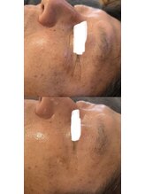 アンジェリーナ(Angelina.)/メンズハーブ★ビフォーアフター