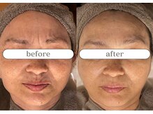 リスタ(RSTA)/【BEFORE/AFTER】