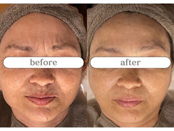 リスタ(RSTA)/【BEFORE/AFTER】