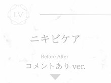 ラヴィオーラ 西宮北口店(La Viora)/ダイヤモンドハーブピーリング