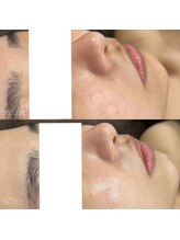 シャルム(Charme.)/ハーブピーリング