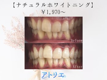 アトリエ 横浜店/ホワイトニングで人生が変わる