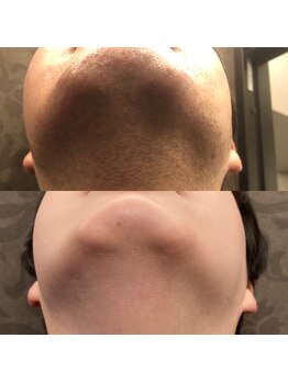 フェリーバ 流山店(FELIVA)/青髭がなくなりお肌も綺麗に。