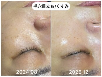 フラックス 京都(FLUX)/【エンビロン】たるみ毛穴コース