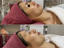 GRACETHOUSAND(グレイスサウザンド)/ハーブピーリング/くすみ/たるみ