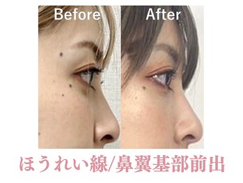 ラプリボヤージュ 藤沢店(Raplit)/ 隆鼻＋輪郭矯正40分10回コース