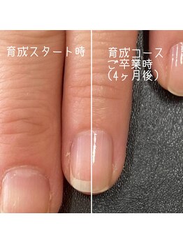ネイルズ アヴァンティ(Nails Avanti)/割れやすい爪を育成4ヶ月コース
