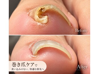 ミリアネイル 成城(Miliea nail)の写真/【巻き爪のお悩みに】食い込み・痛みをケアして、快適に歩ける足元へ♪