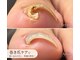 ミリアネイル 成城(Miliea nail)の写真/【巻き爪のお悩みに】食い込み・痛みをケアして、快適に歩ける足元へ♪
