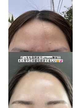 ポレ(pole)/肌荒れしにくい肌へ改善☆