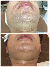 ルーメ(lume)/脱毛40代男性