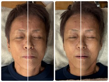 アメリオレ(ameliorer)/小顔矯正