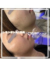 ビーマジック(美magic)/レモンボトル2cc