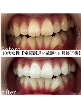 ホワイト 福岡天神店(WHITE)/ホワイトニングビフォーアフター