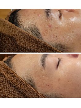 サロン ポム(salon pom)/◇ニキビ肌BeforeAｆter◇