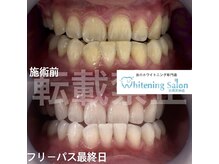 ホワイトニングサロン 福岡天神店/ホワイトニング