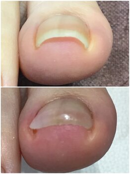 モアクリスタル(More Crystal)/巻き爪補正