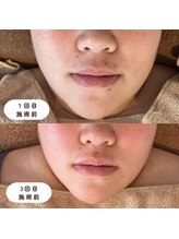 ウーマンビーヘルス(woman Be Health)/ハーブピーリング3回