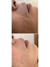 【40代50代の女性に人気】たるみ改善美容鍼＋毛穴ケア美容液