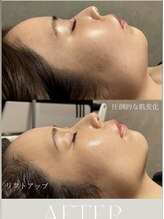 モモ(momo)/跡にお悩みの方！