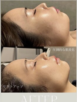 モモ(momo)/跡にお悩みの方！