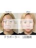 2回目以降！《即小顔＆たるみケア》表情筋トレ！テラボーラーフェイシャル
