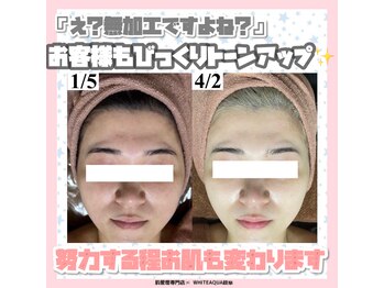 ホワイトアクア 岐阜店(WHITE AQUA)/ハーブピーリング/岐阜/ニキビ