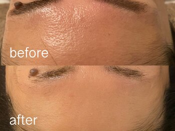 エムフロート(M float)/ハーブピーリング|毛穴