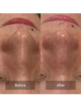 マヴィ(Mavie)/韓国式3D毛穴洗浄