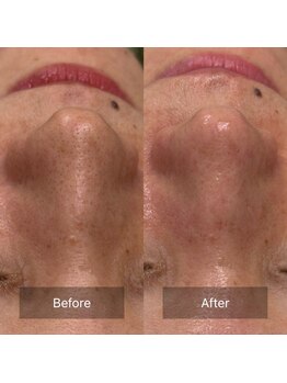 マヴィ(Mavie)/韓国式3D毛穴洗浄