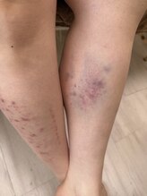 コル コルエ(koru korue)/脚の重だるさ