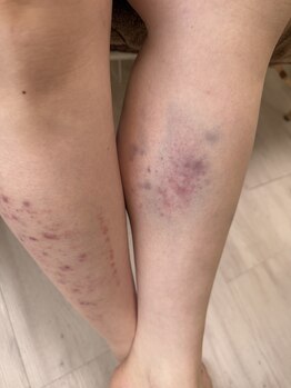 コル コルエ(koru korue)/脚の重だるさ